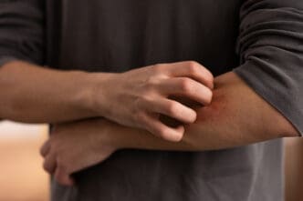Person dealing with psoriasis